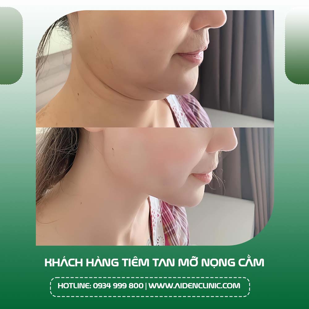 Tiêm tan mỡ nọng cằm thon gọn mặt