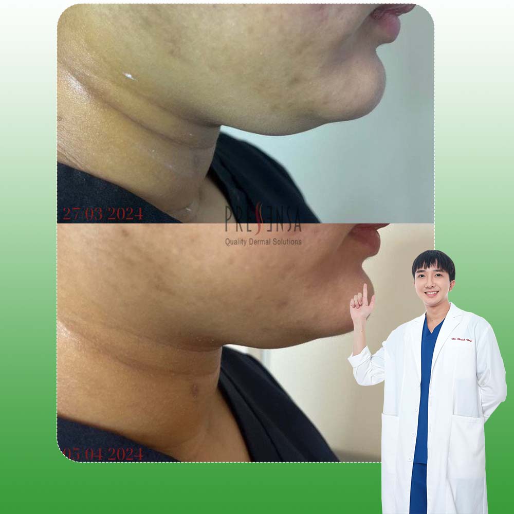 Tiêm tan mỡ nọng cằm thon gọn mặt