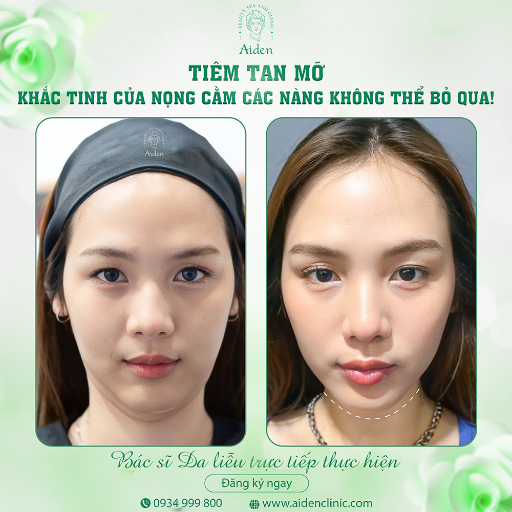 TIÊM TAN MỠ NỌNG CẰM GIÁ BAO NHIÊU