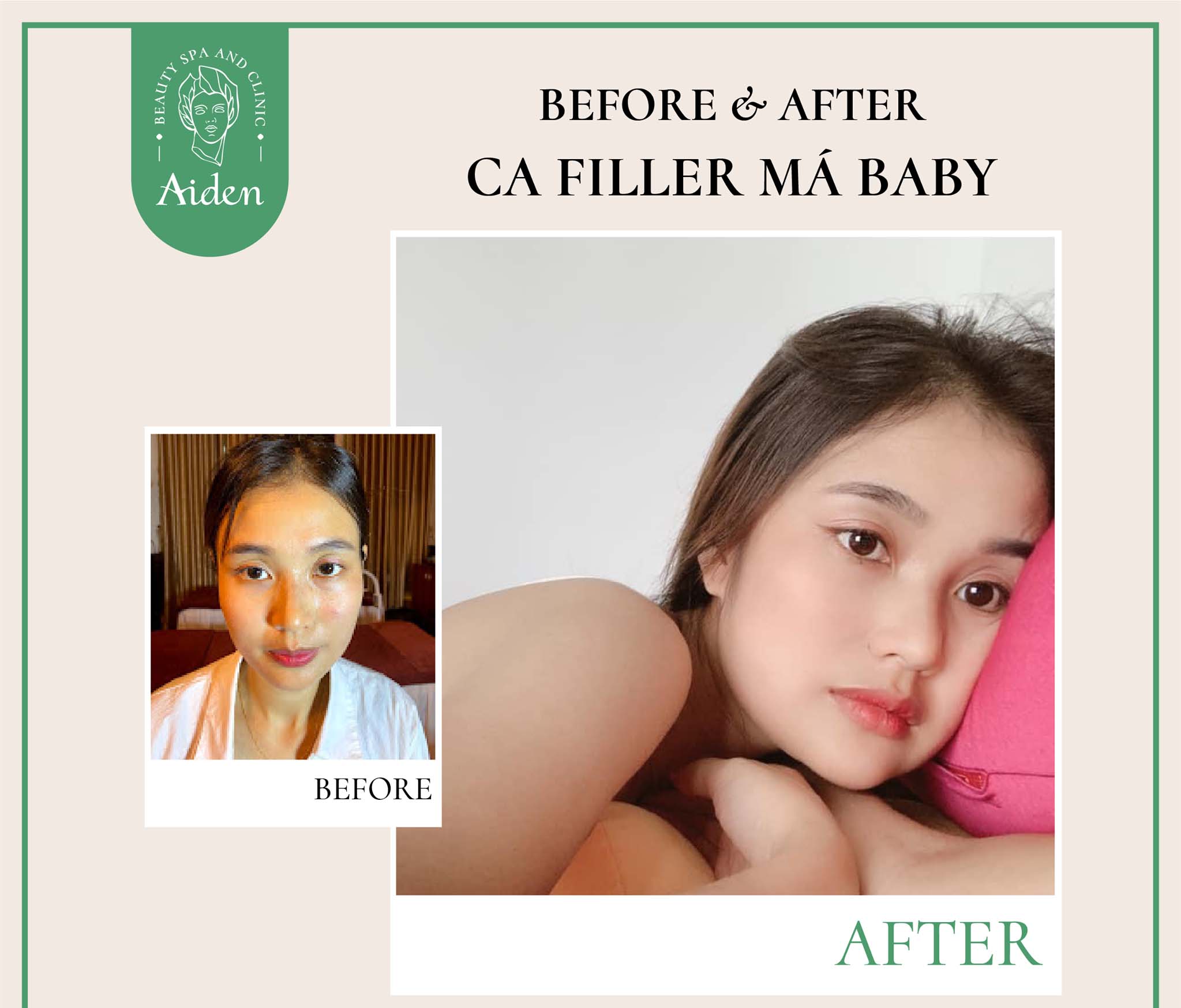 Giới thiệu về cấy HA collagen má baby - Thẩm Mỹ Viện Aiden Beauty Spa ...
