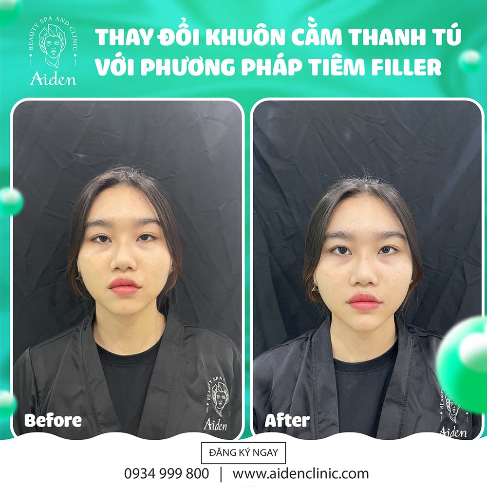 TIÊM FILLER CẰM GIÁ BAO NHIÊU TÙY THUỘC VÀO LOẠI CHẤT LÀM ĐẦY VÀ CƠ SỞ THỰC HIỆN