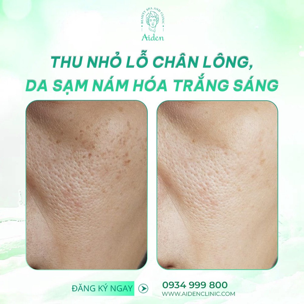 dieu-tri-lo-chan-long-to-bang-Laser-co2-fractional