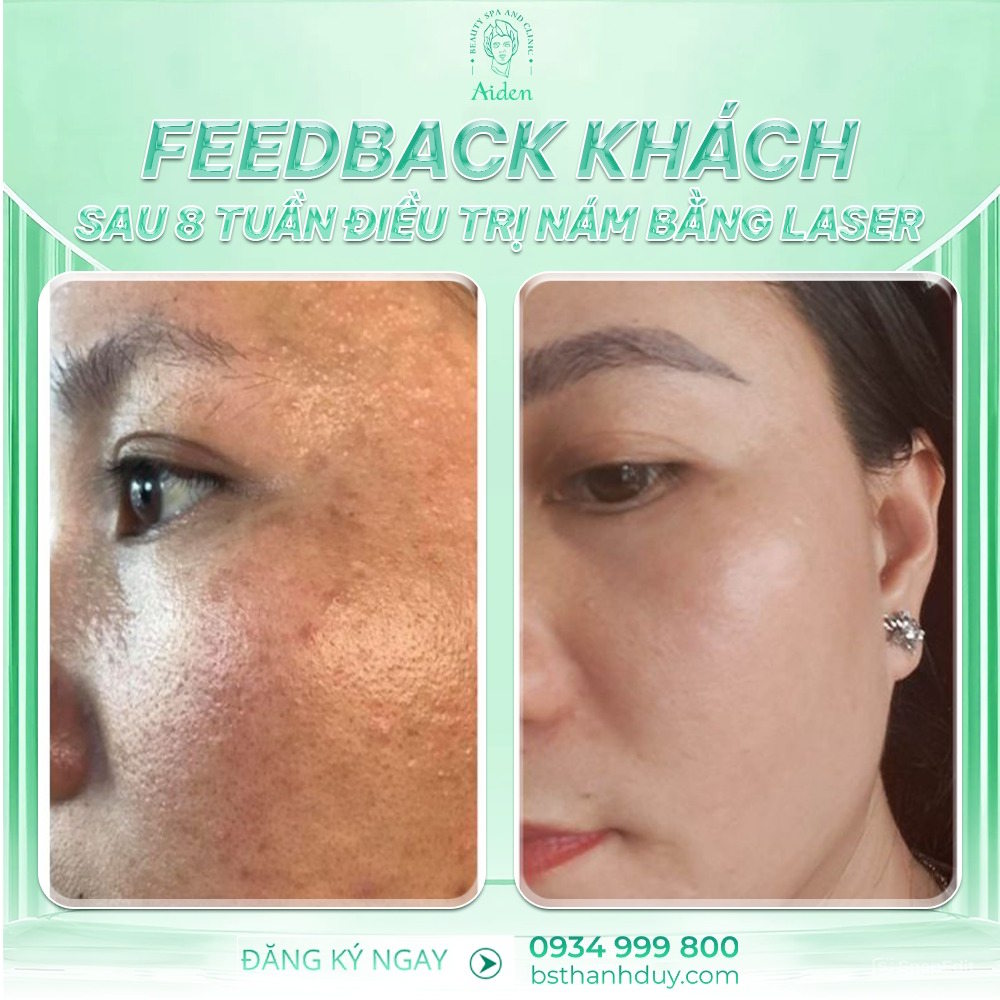 feedback-phac-do-dieu-tri-nam-bang-laser