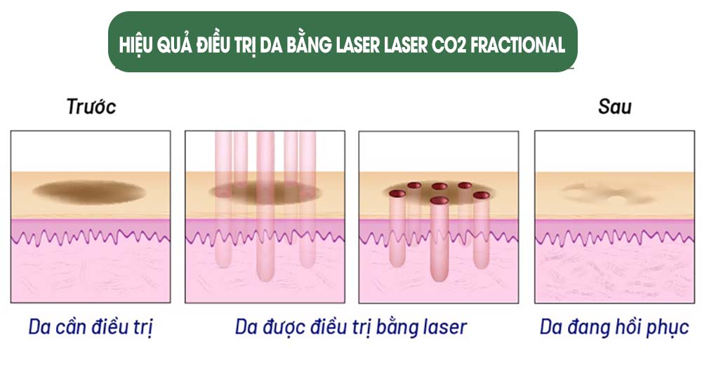 quy-trinh-co-ban-laser-co2-fractional-tai-aiden