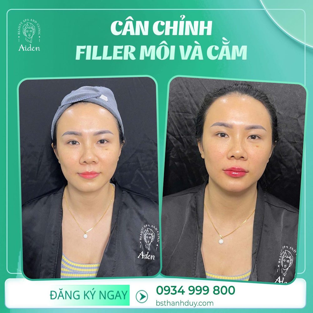 tiem-filler-la-gi-co-an-toan-khong