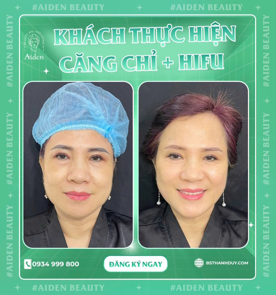 hieu-qua-sau-khi-cang-chi-collagen-tre-hoa