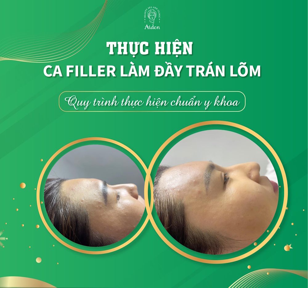 tiem-filler-lam-day-tran-lom