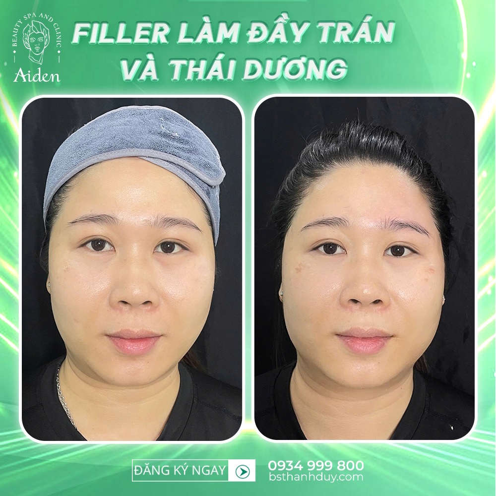 tiem-filler-lam-day-tran