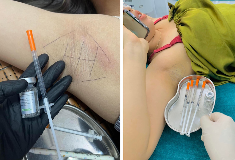 bac-si-tiem-botox-giam-mui-hoi-duoi-canh-tay