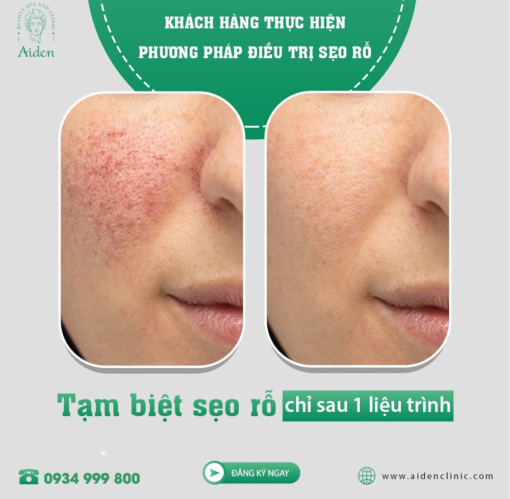 Tuyển mẫu điều trị sẹo
