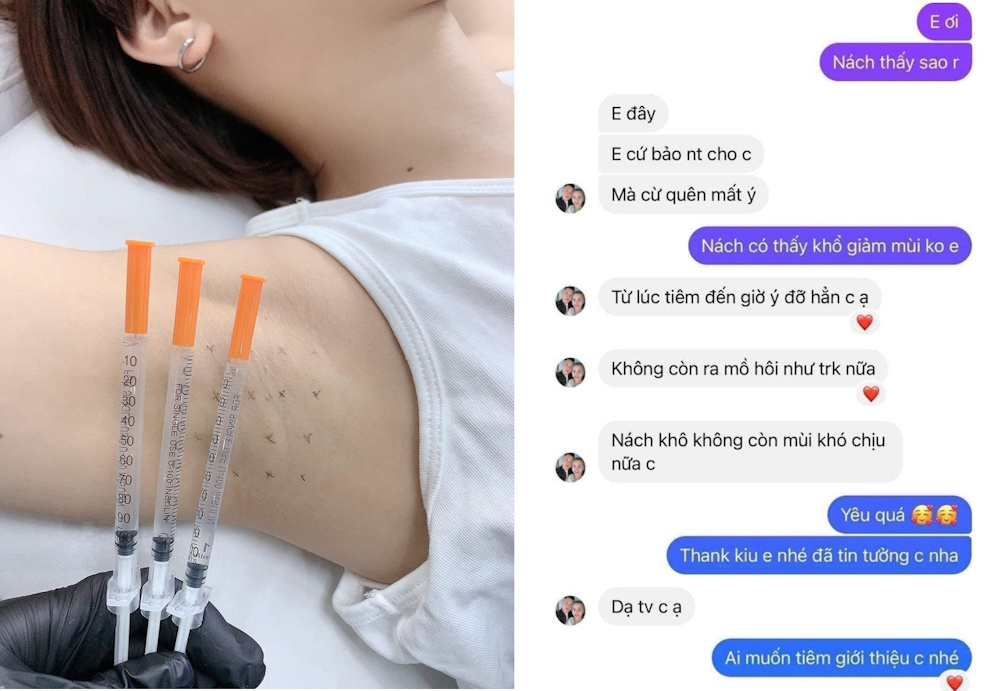 tiem-botox-khu-mo-hoi-duoi-canh-tay