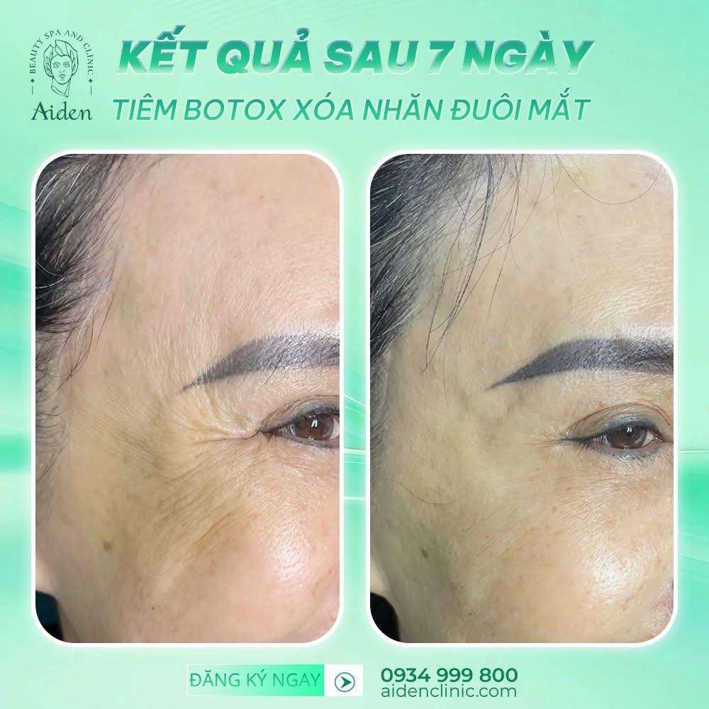cong-dung-cua-tiem-botox-xoa-nhan-duoi-mat
