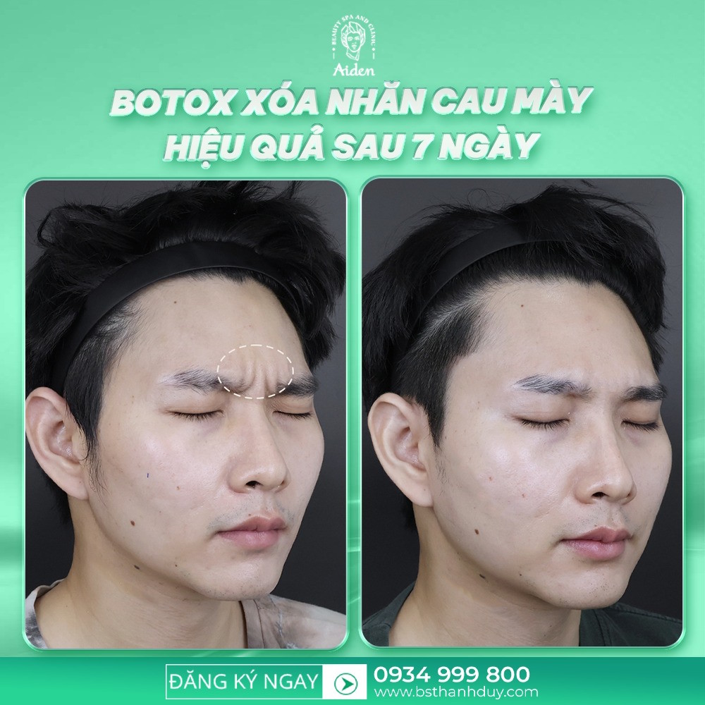 /cong-dung-cua-tiem-botox