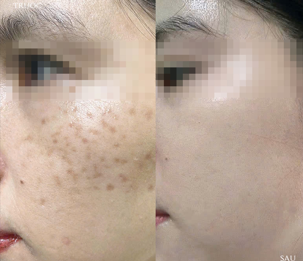 laser điều trị tàn nhang