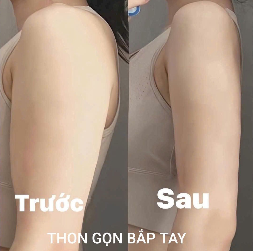 hinh-anh-truoc-va-sau-khi-tiem-botox-thon-gon-tay