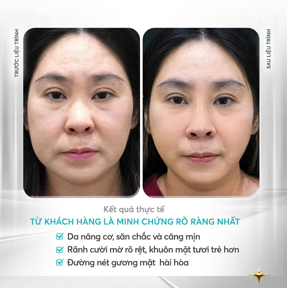 ket-qua-sau-khi-thuc-hien-Ultherapy