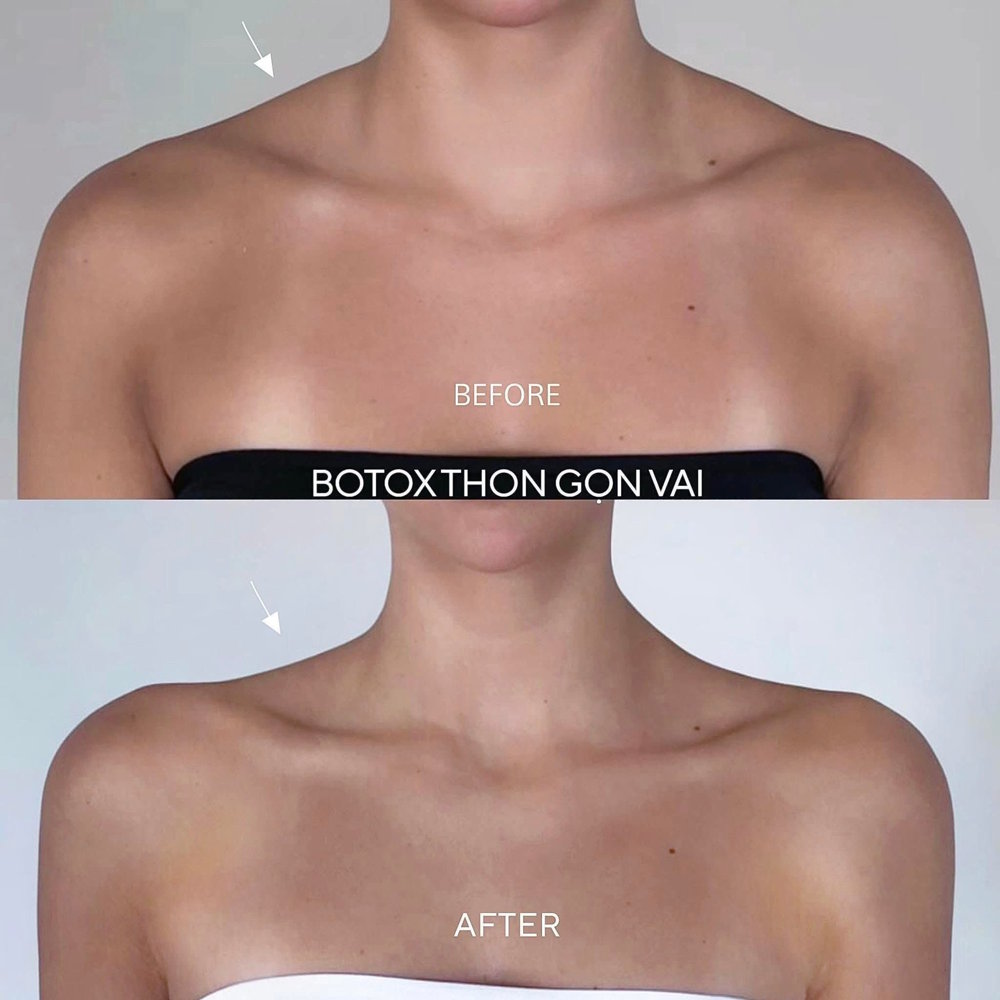 ket-qua-tiem-botox-thon-gon-vai-aiden