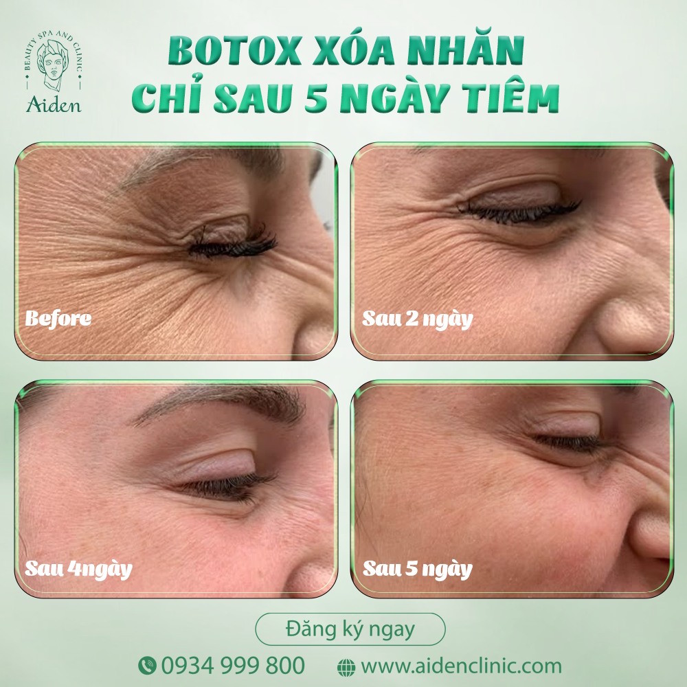 tiem-botox-xoa-nhan-hieu-qua-sau-7-ngay
