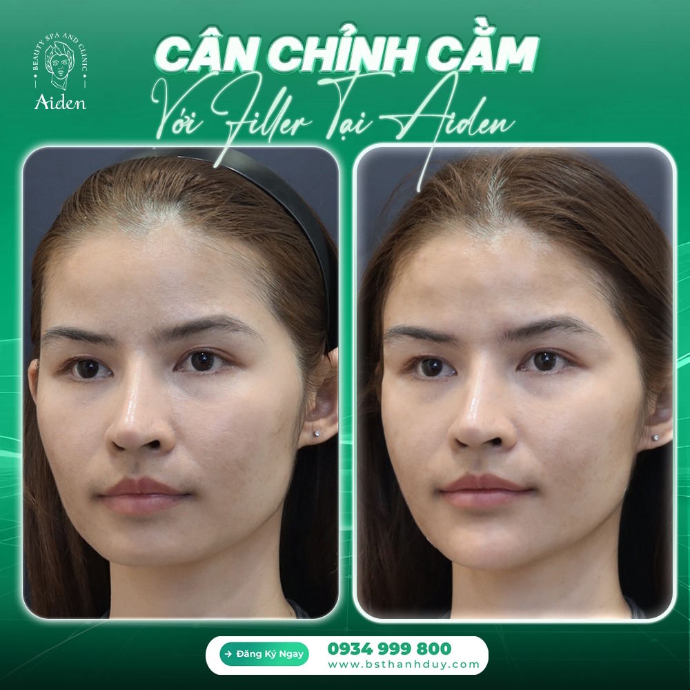 tiem-filler-co-bi-chay-xe-khong