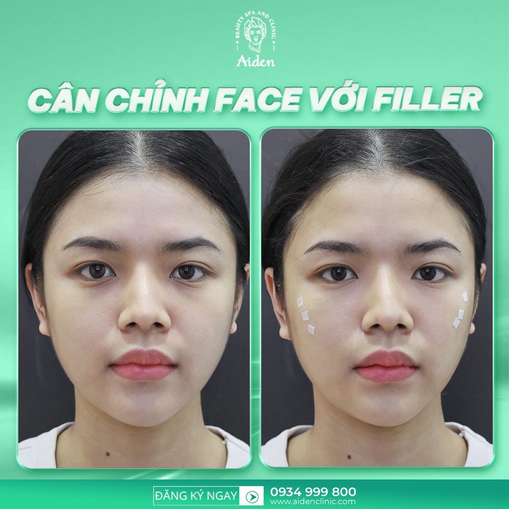 tiem-filler-khong-bi-chay-xe