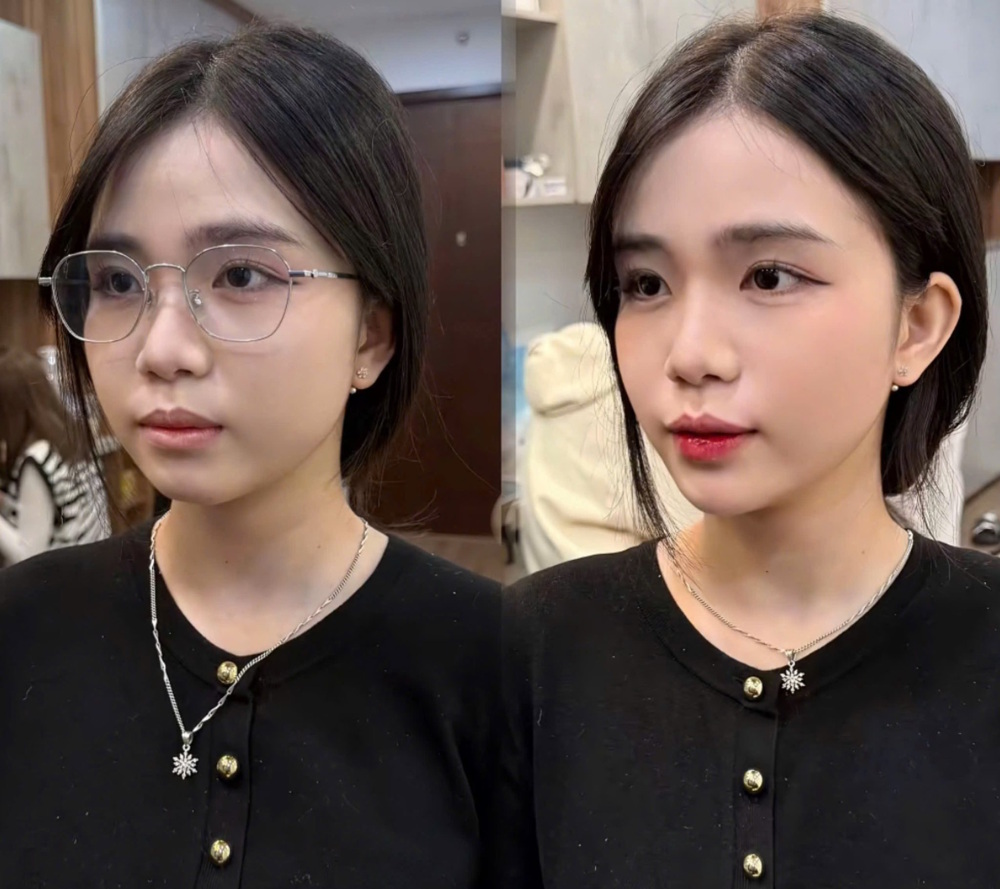 tiem-filler-ma-baby-giu-duoc-bao-lau
