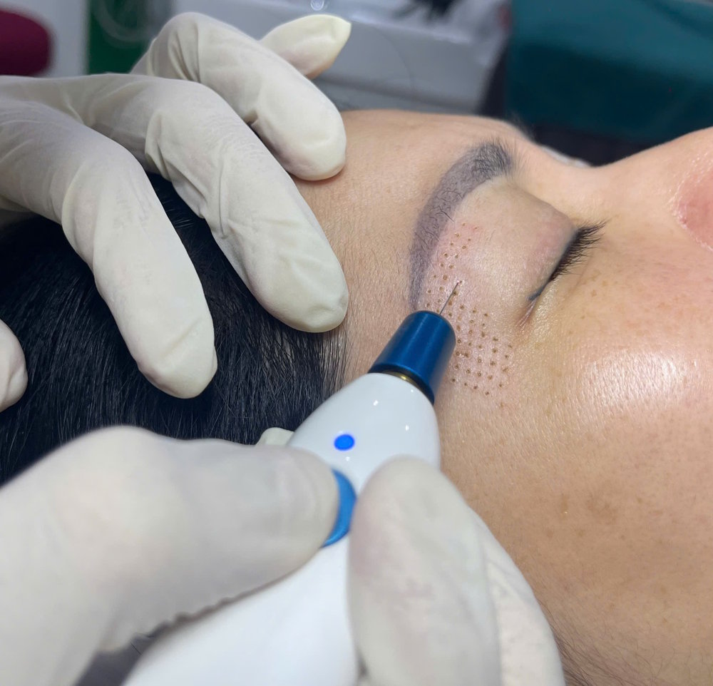 Công nghệ plasma tái tạo da mặt