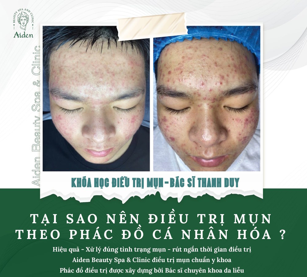 SẢN PHẨM KEM ĐẶC TRỊ MỤN TH BEAUTY DẠNG TUÝP NHỎ GỌN TIỆN LỢI MANG THEO