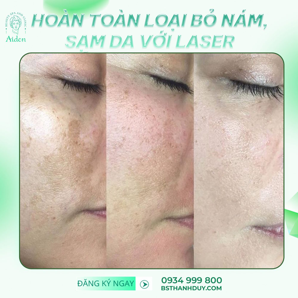 Nám da có chữa khỏi hoàn toàn không