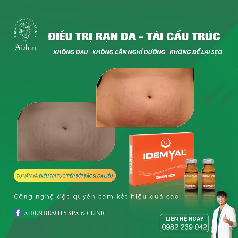 Rạn da lâu năm có điều trị được không