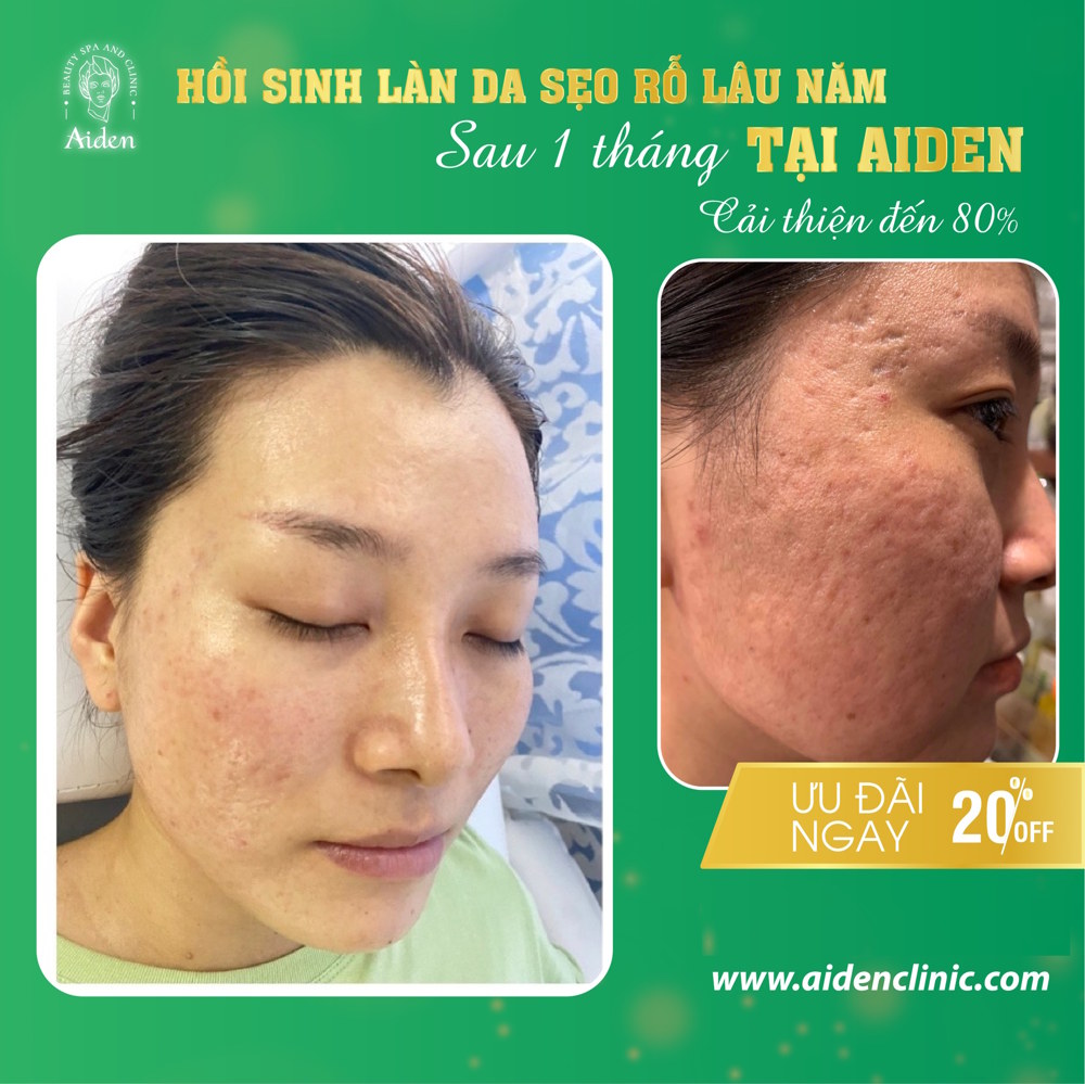 Ưu điểm Laser CO2 Fractional