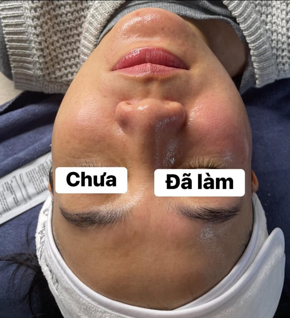 hieu-qua-nang-co-song-rf
