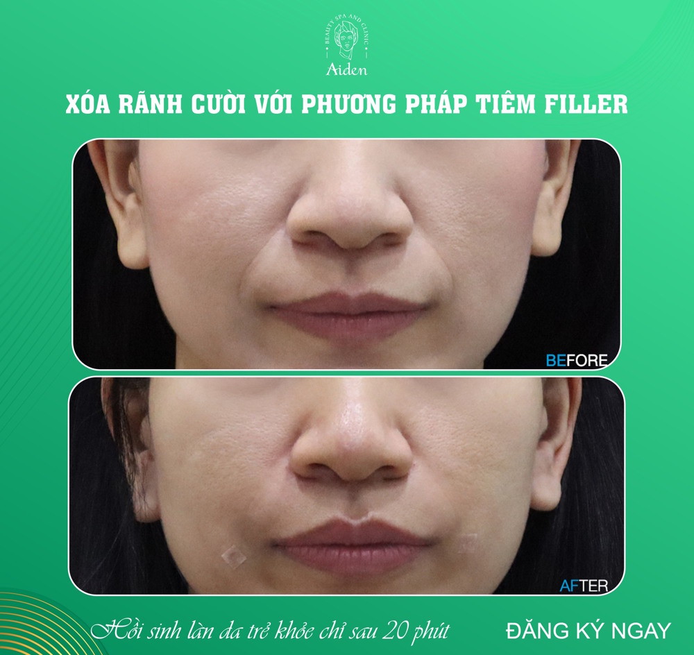 Smile Lines Filler DR THANH DUY