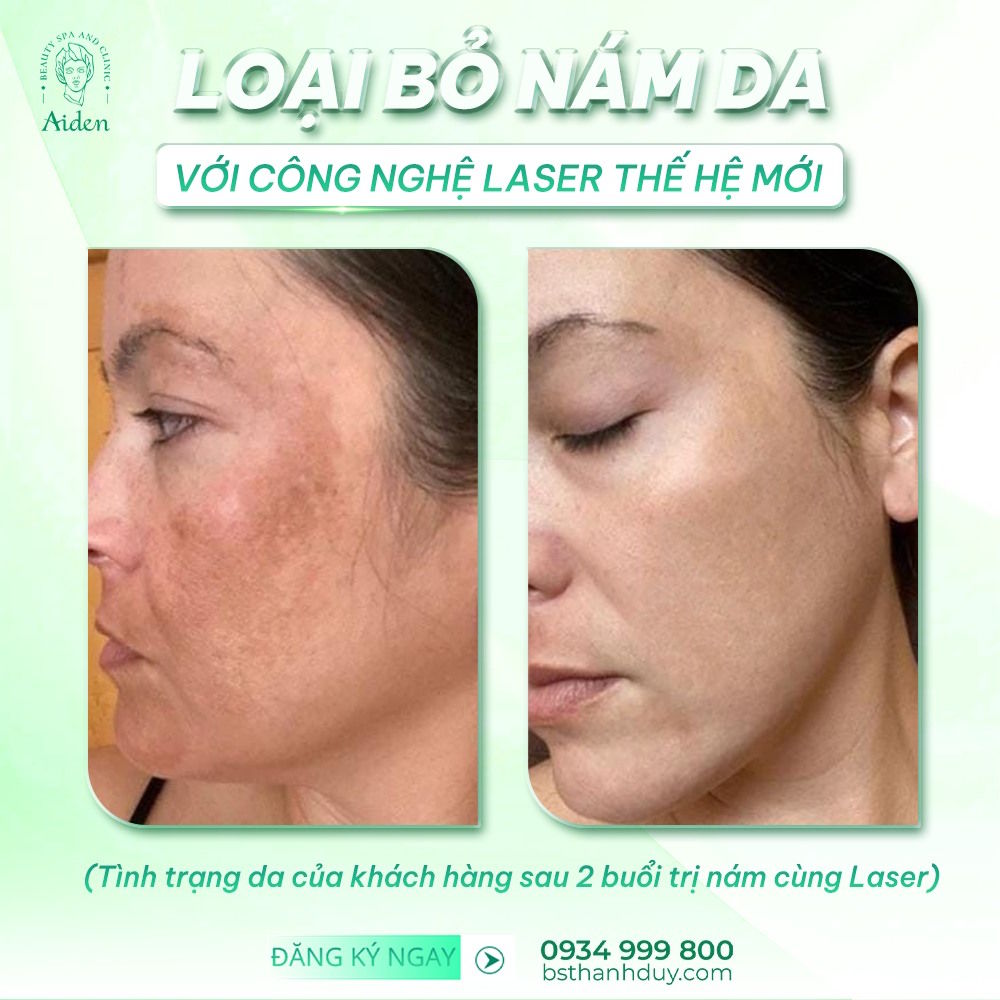 Điều trị nám bằng laser pico
