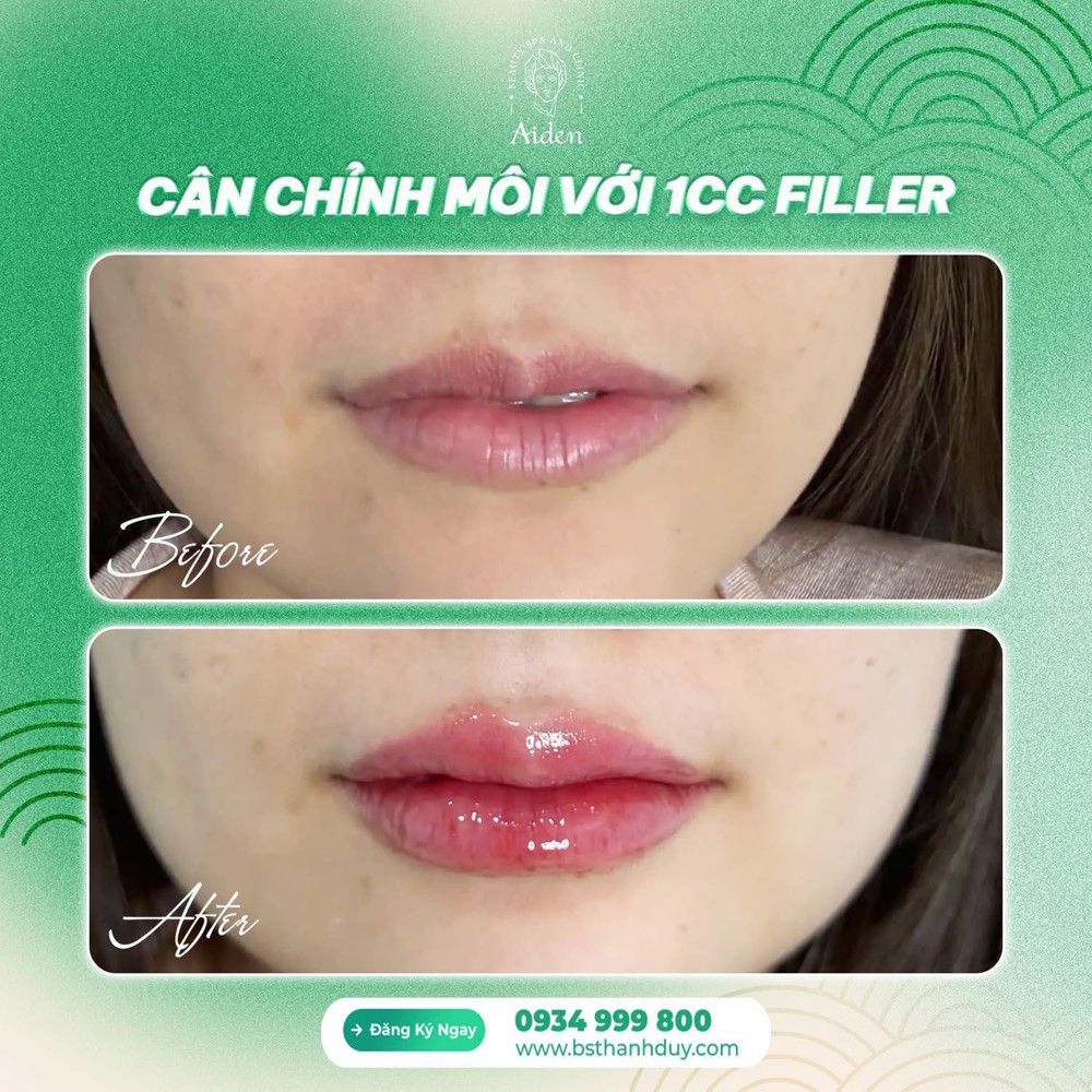 nan-can-chinh-moi-sau-khi-tiem-filler