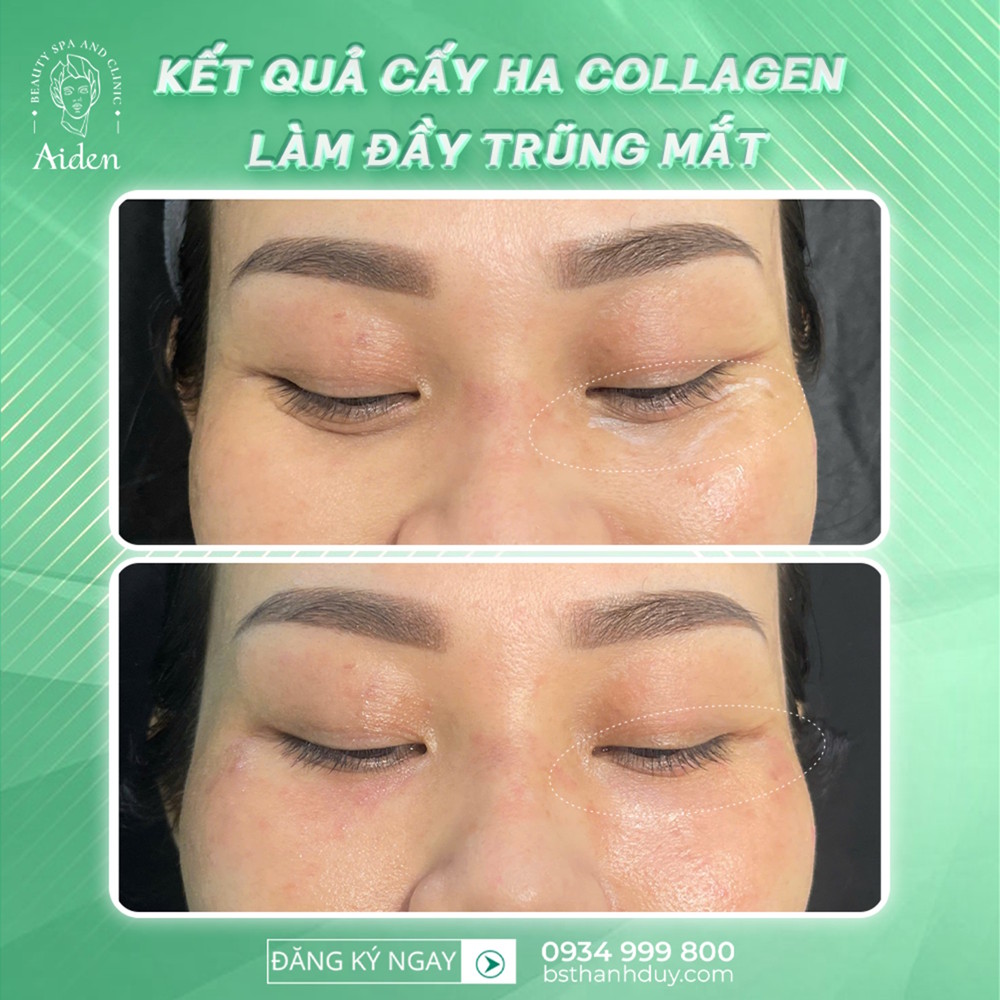 tiem-filler-lam-day-trung-mat