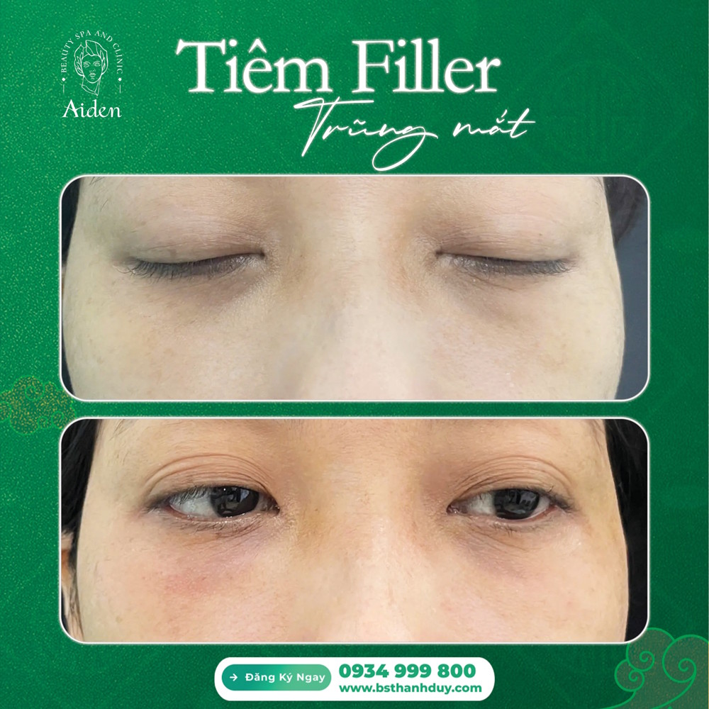 tiem-filler-trung-ma