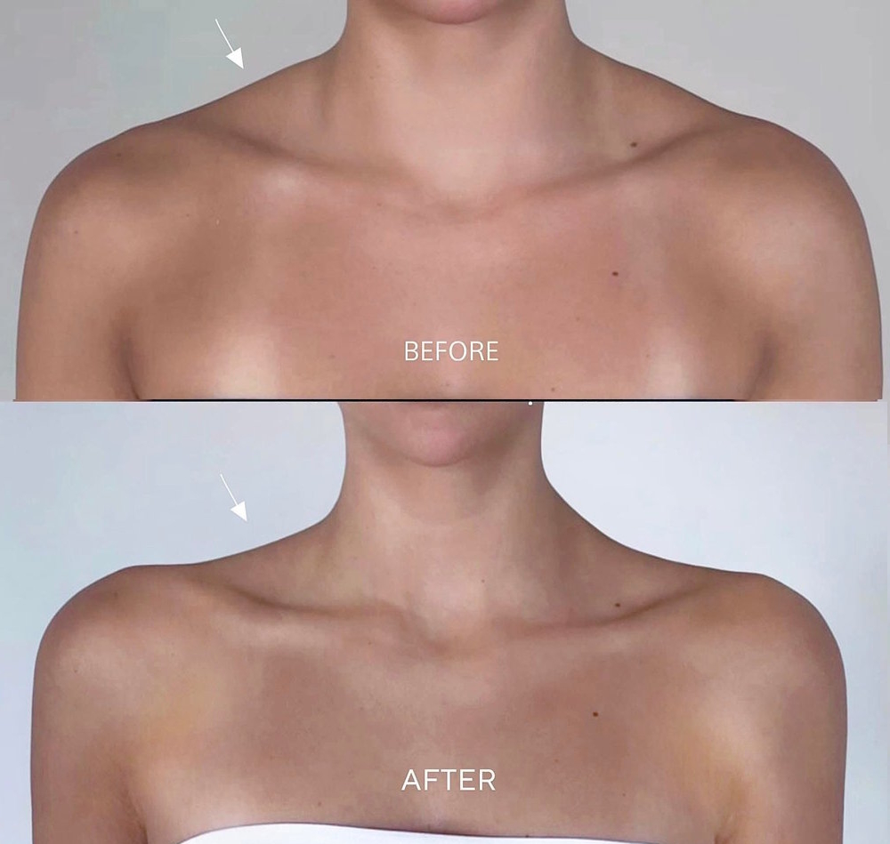 shoulder-filler-injection-aiden