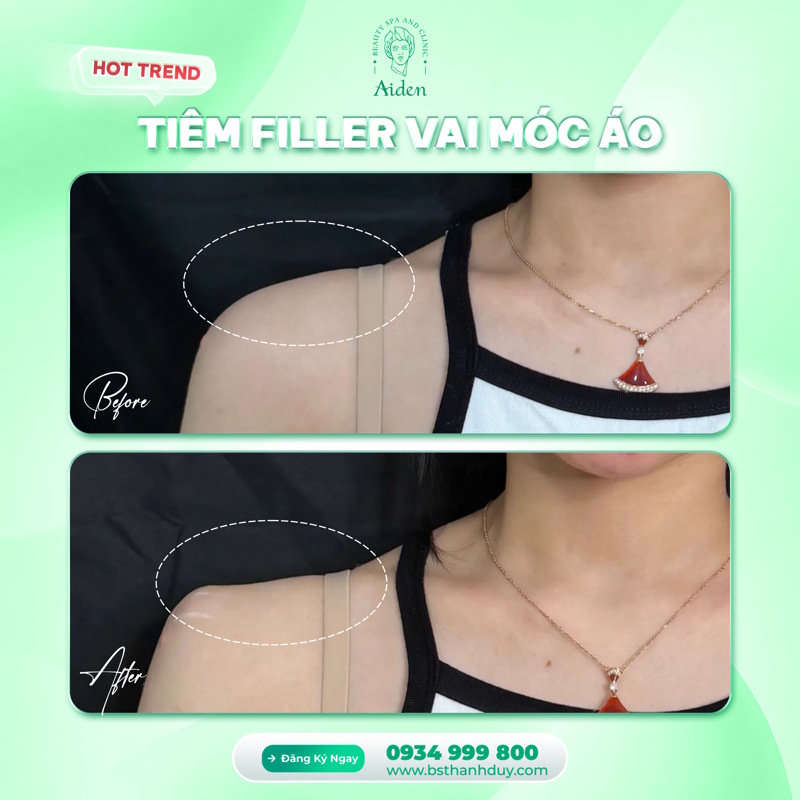 shoulder-filler-injection