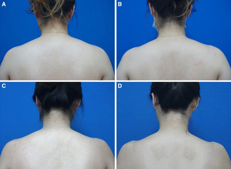 shoulder-filler-injection