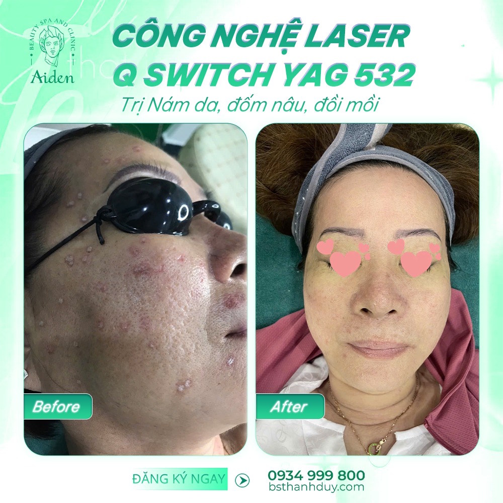 laser điều trị tàn nhang hiệu quả