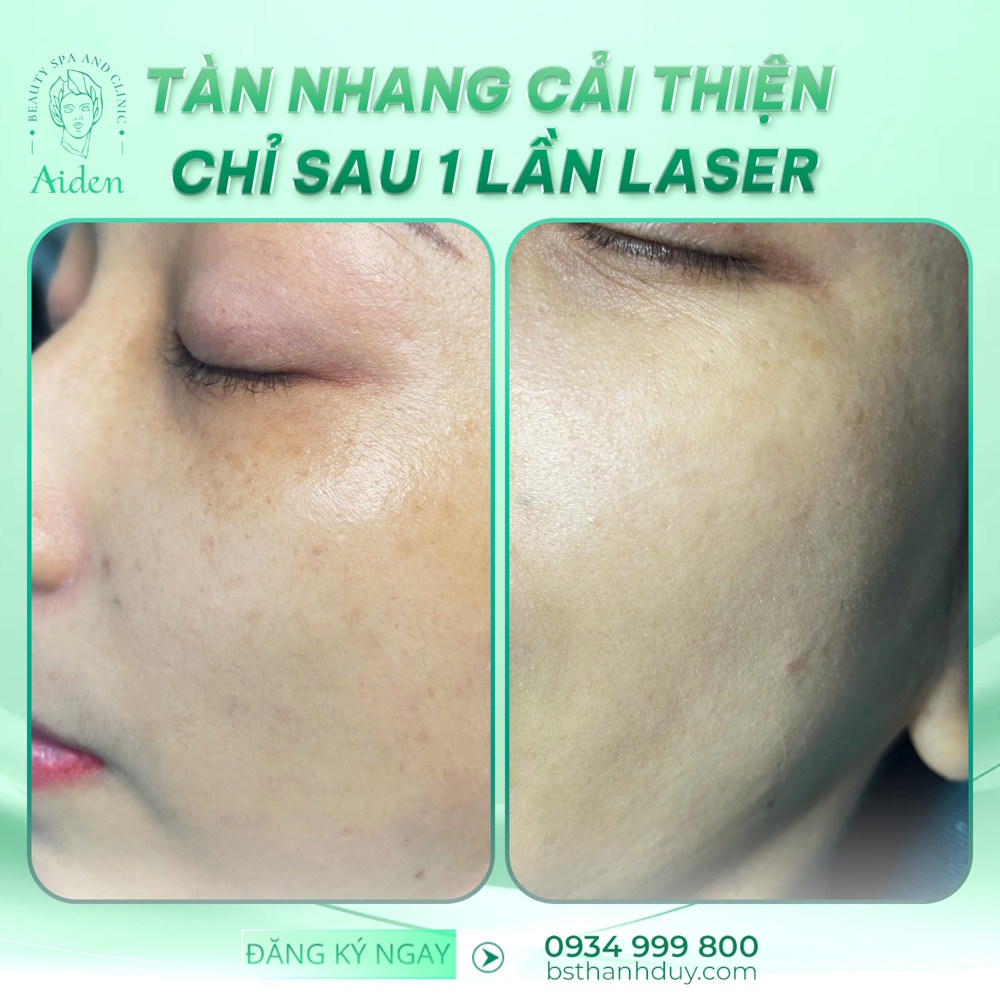 Công nghệ điều trị tàn nhang hiện đại giúp cải thiện sắc tố da