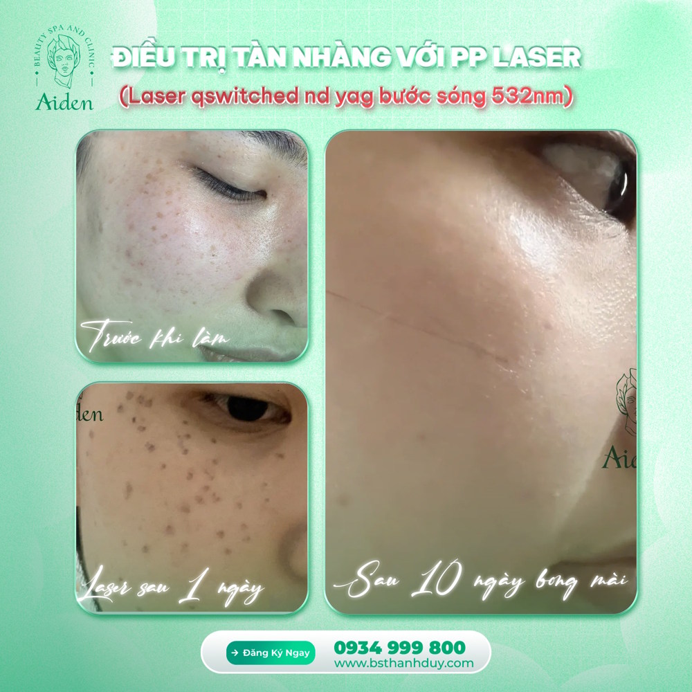 laser điều trị tàn nhang hiện đại giúp cải thiện sắc tố da