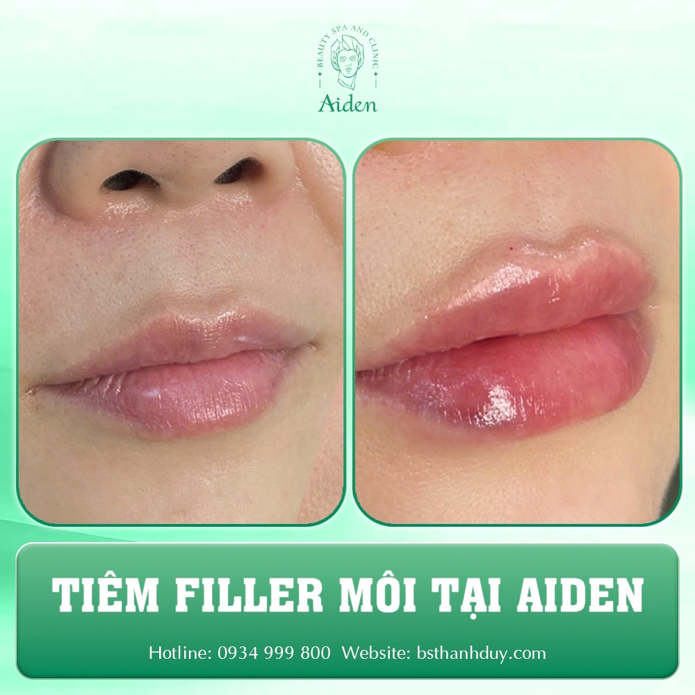 tiem-filler-can-chinh-moi-lech-gia-bao-nhieu