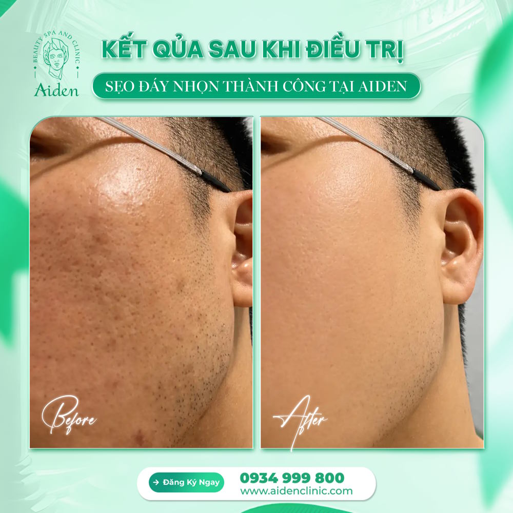 Ưu điểm Laser CO2 Fractional