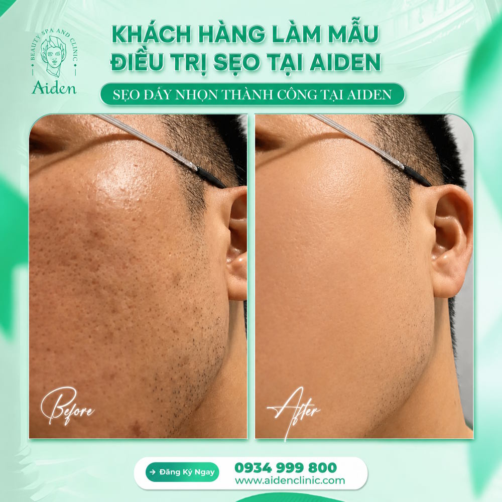 Tuyển mẫu điều trị sẹo