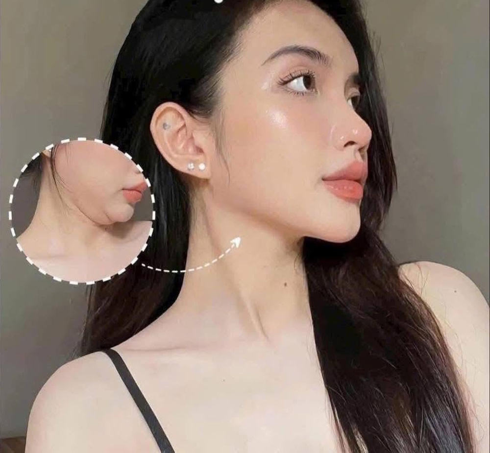Tiêm tan mỡ nọng cằm thon gọn mặt