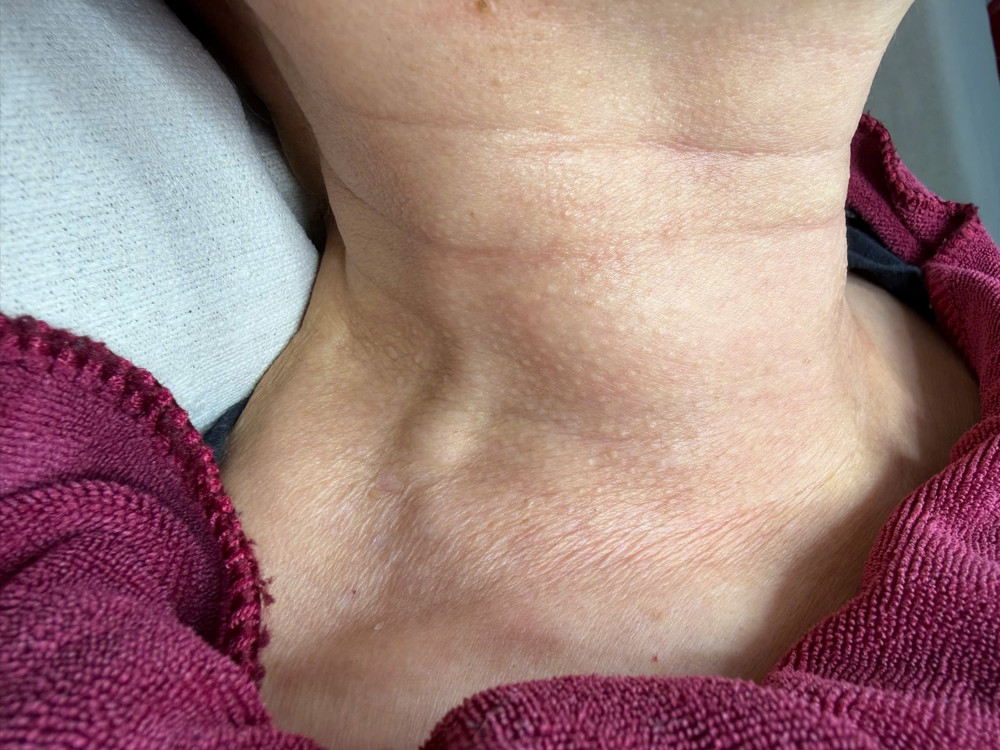 Trẻ hóa vùng cổ da gà bằng Laser