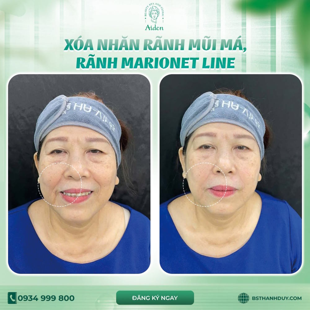 Top Destination for Premium Filler Injections
