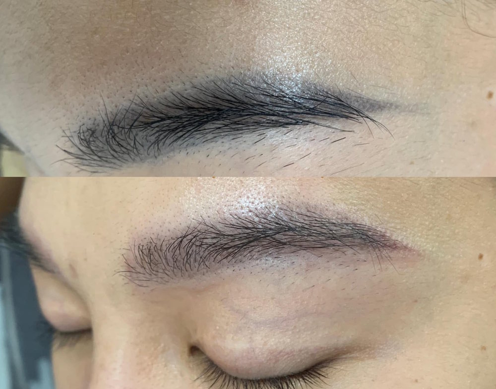 giá xóa xăm lông mày bằng laser