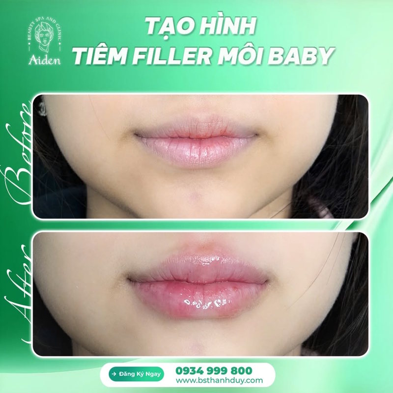 Cấy HA Collagen môi